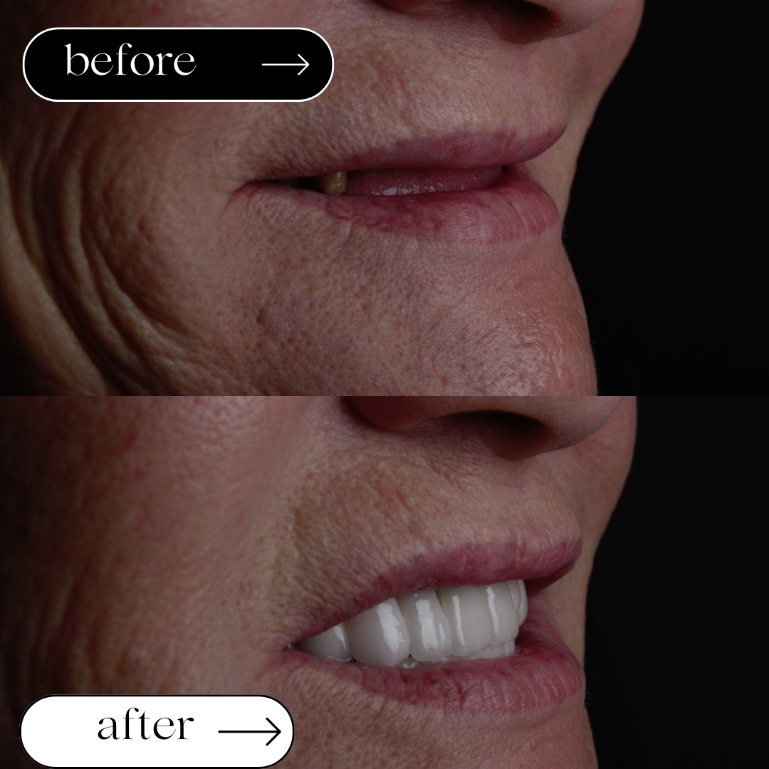 Fall 3: All-on-4 Versorgung - Before and after dental transformation