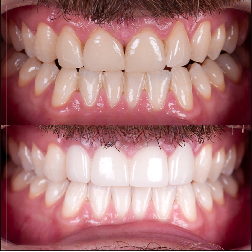 Smile transformation 1