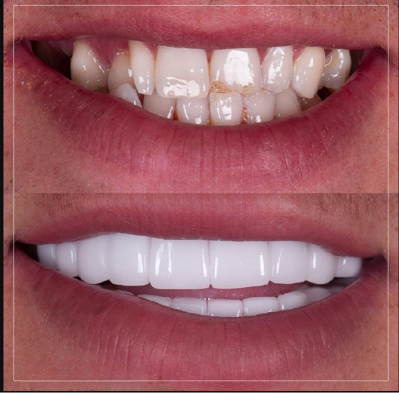 Smile transformation 2