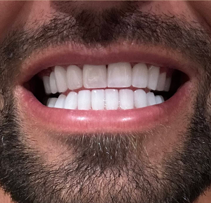 Fall 2: Vollkeramikkronen - Before and after dental transformation
